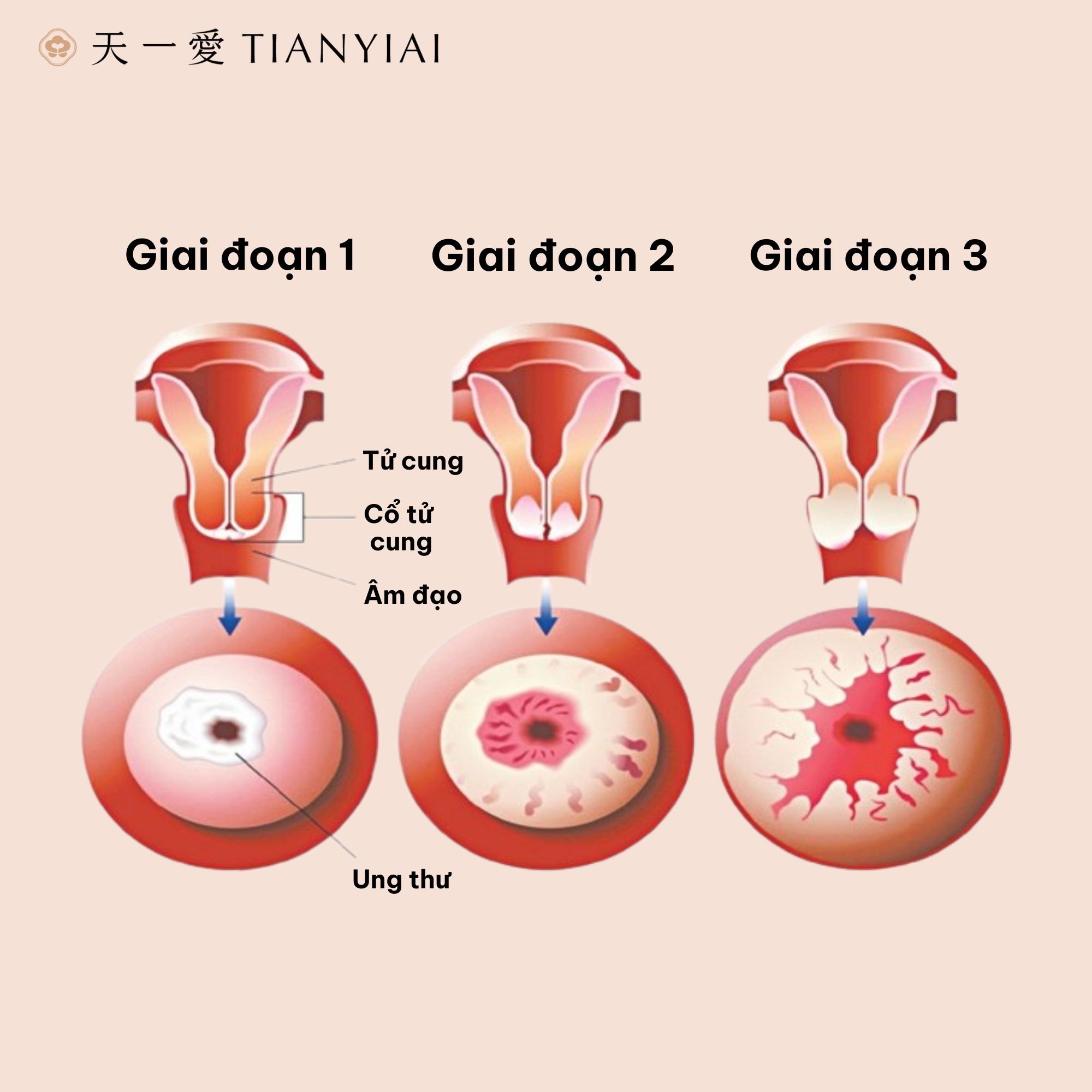 Giai đoạn phát triển ung thư cổ tử cung:1. Ung thư chưa lan xa khỏi tử cung. 2. Khối u đã lan xa hơn, nhưng vẫn nằm trong khu vực tiết niệu. 3. Tế bào ung thư đã lan xa khỏi khu vực tiết niệu và di căn đến các bộ phận khác. 4. Khối u đã lan sang vùng chậu, bàng quang, phổi, gan, xương