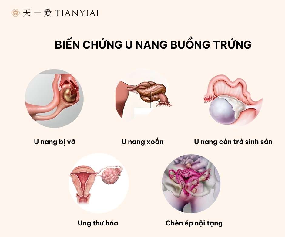 Bien-chung-cua-u-nang-buong-trung