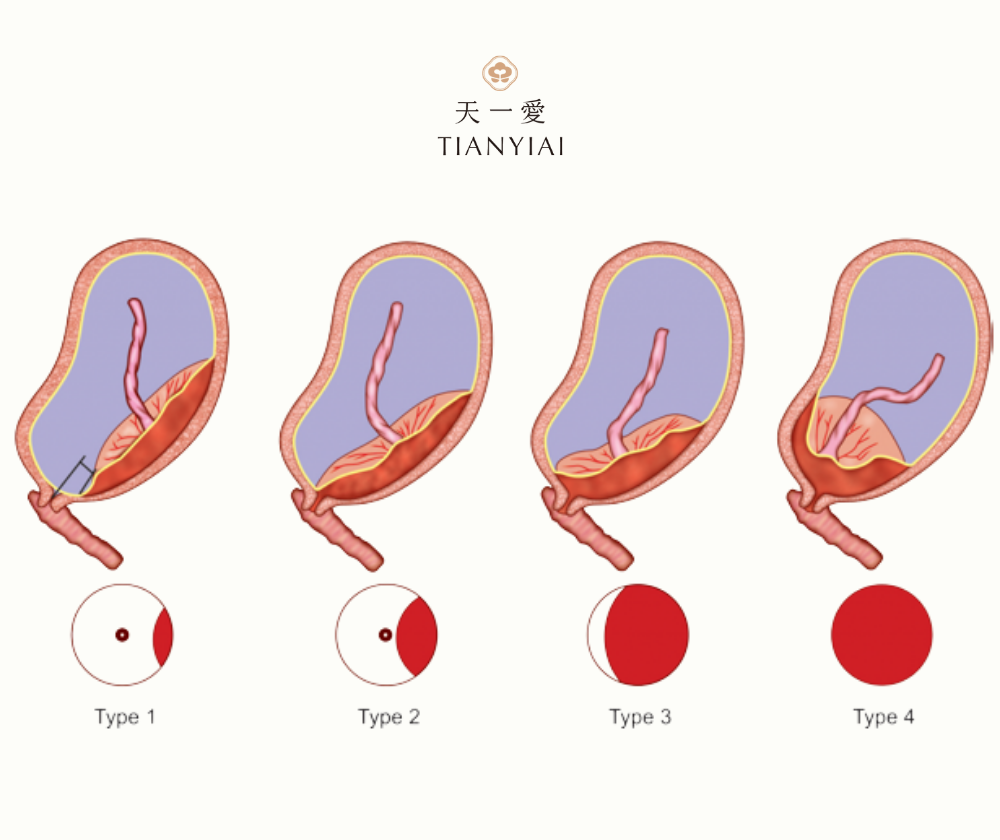 Các loại nhau tiền đạo