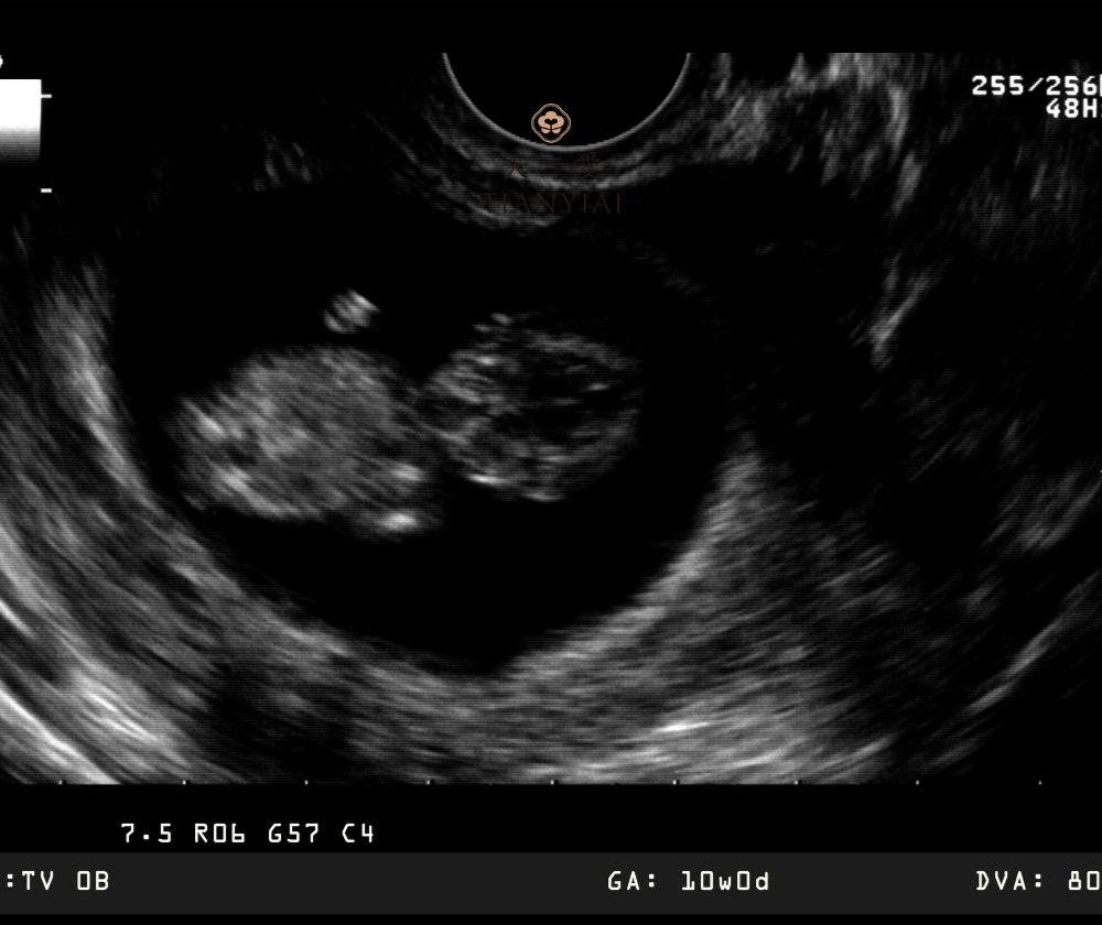 Xét nghiệm NIPT có thể làm từ tuần thai thứ 10